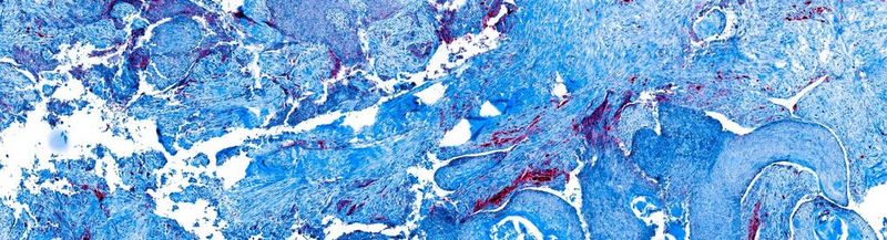 Research sample slide of tumour tissue where cells have been stained for different proteins using a fluorescently tagged antibody. Presented as false colour blue/red image on white background.
