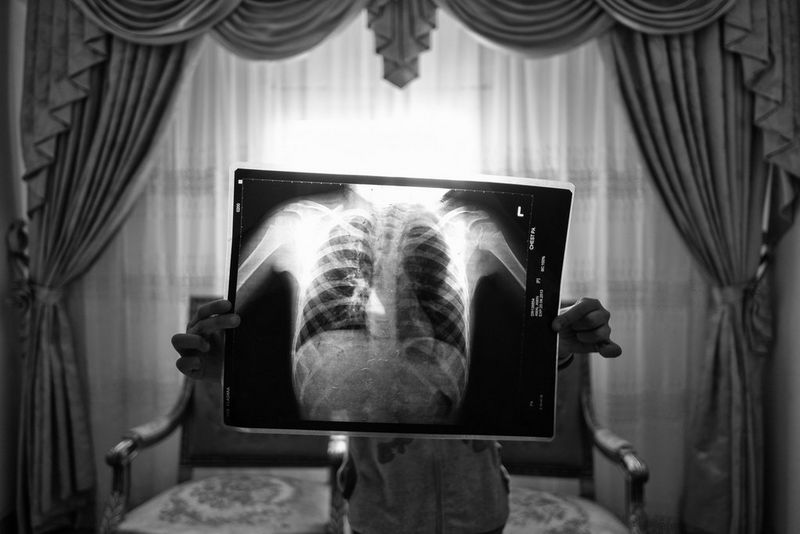 Una fotografia monocromatica scattata da Mohamed Mahdy che raffigura una bambina con in mano una radiografia dei suoi polmoni danneggiati, davanti a una finestra con le tende.