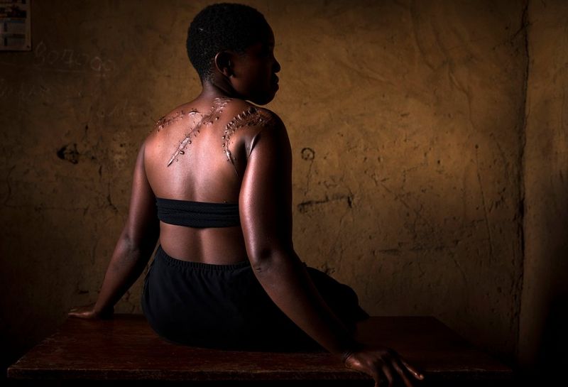 A woman with scars on her upper back sits facing away from the camera, photographed by Brent Stirton.
