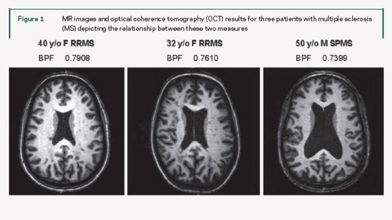 Three brain scans, side by side. Each scan has a central black are that increases in size as the brain parenchymal fraction (shown in numbers above) decreases. Beneath the scans shows the corresponding OCT results. Above the scans is written "MR images and optical coherence tomography (OCT) results for three patients with multiple sclerosis (MS) depicting the relationship between these two measures.