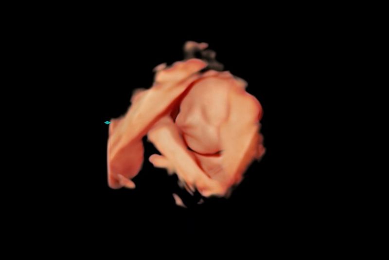 Ultrazvukový snímek miminka od odborníka na ultrazvuk, lékaře Billa Smithe, nezobrazující žádnou simulaci poruchy zraku