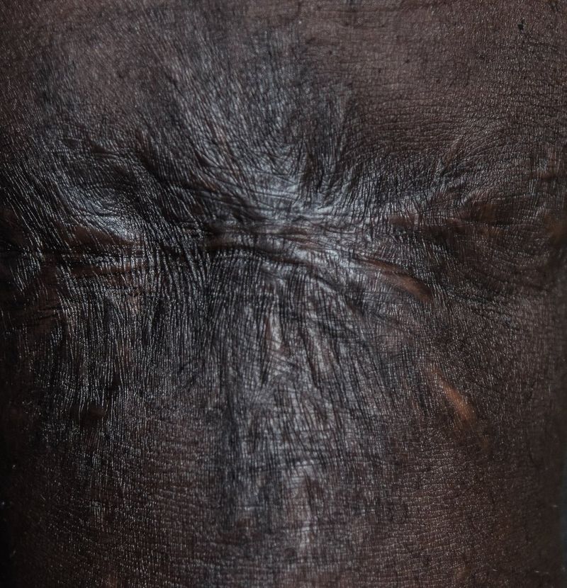A close-up of a thick scar on black skin, showing the detail of the skin’s tension lines and scar tissue.