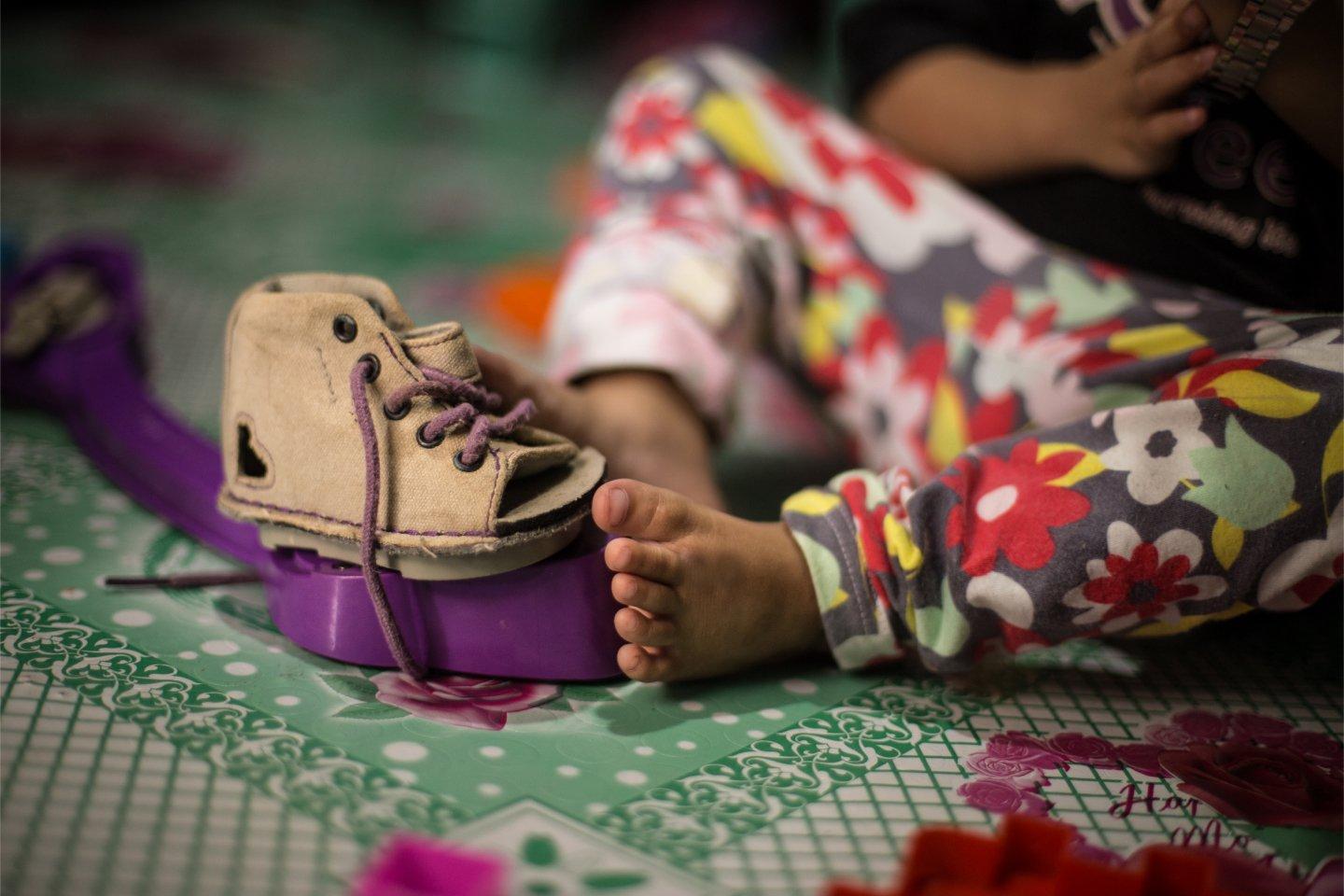 A baby in a plaster cast receiving treatment from MiracleFeet and a young child sat smiling also recieving treatment.