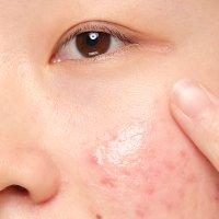 The ORD Sulfur 10 Treatment