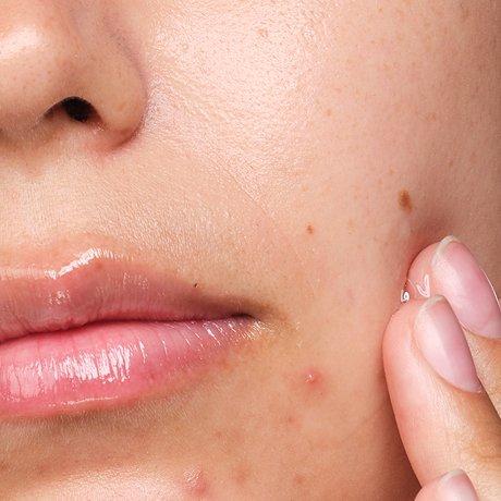 The Ordinary Understanding Spot Solutions For Blemish-Prone Skin