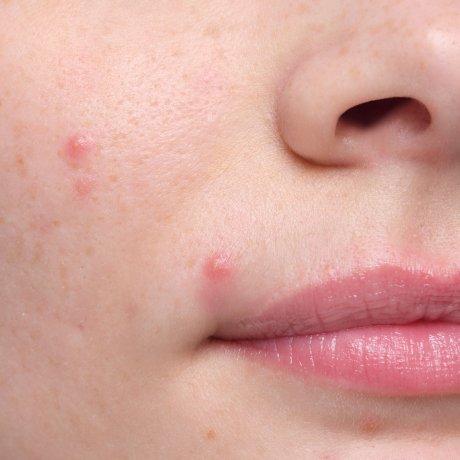 The Ordinary What Causes Breakouts