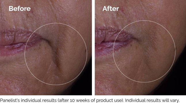 Before and after of The Ordinary GF 15% Solution