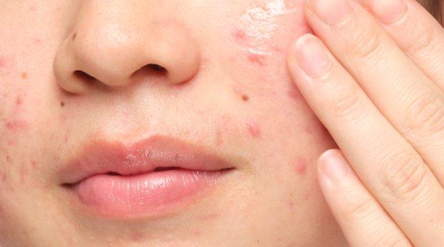 Person applying The Ordinary serum to skin