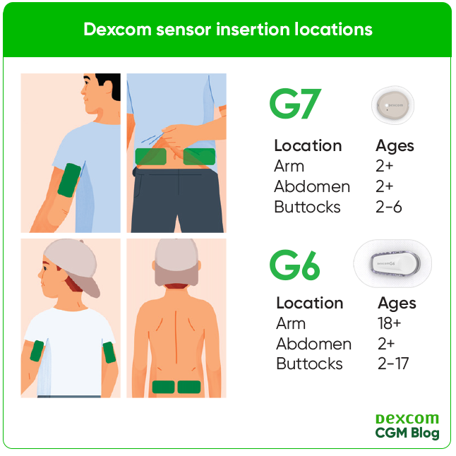 Dexcom G7 wear locations