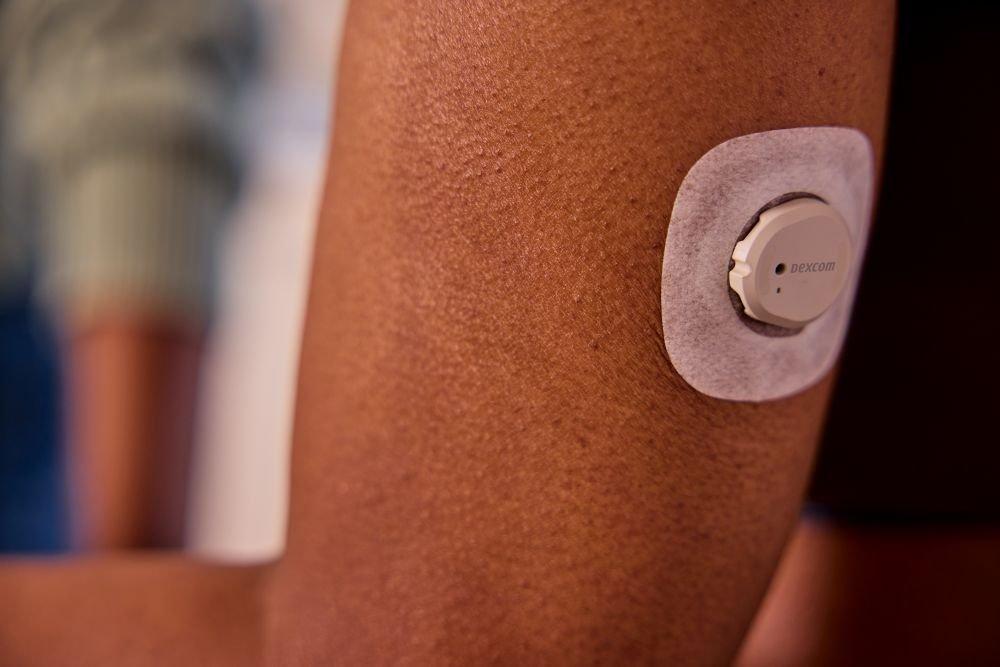 Dexcom G7 CGM sensor for diabetes management