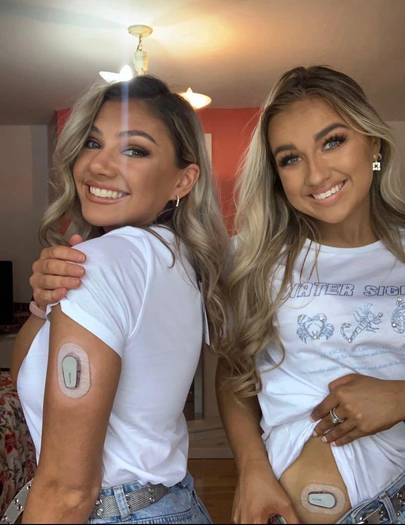 Beth and Ellen showing the Dexcom CGM on the arm and abdomen