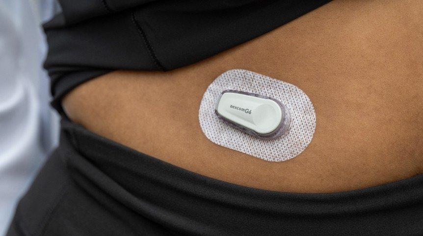 Dexcom G6 sensor on lower abdomen