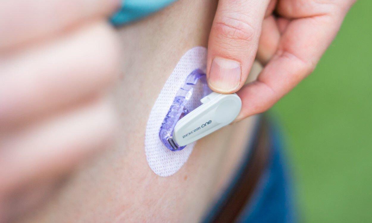Osoba koja primjenjuje senzor Dexcom ONE na abdomen