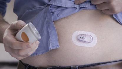 Persoană care ține Dexcom un aplicator și senzor pe abdomen