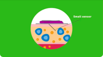 Introductory video of real time continuous glucose monitors (CGM)