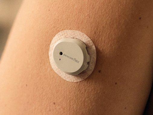 Dexcom Flex Sensor diskret am Oberarm getragen – kontinuierliche Glukosemessung bei Typ‑2‑Diabetes