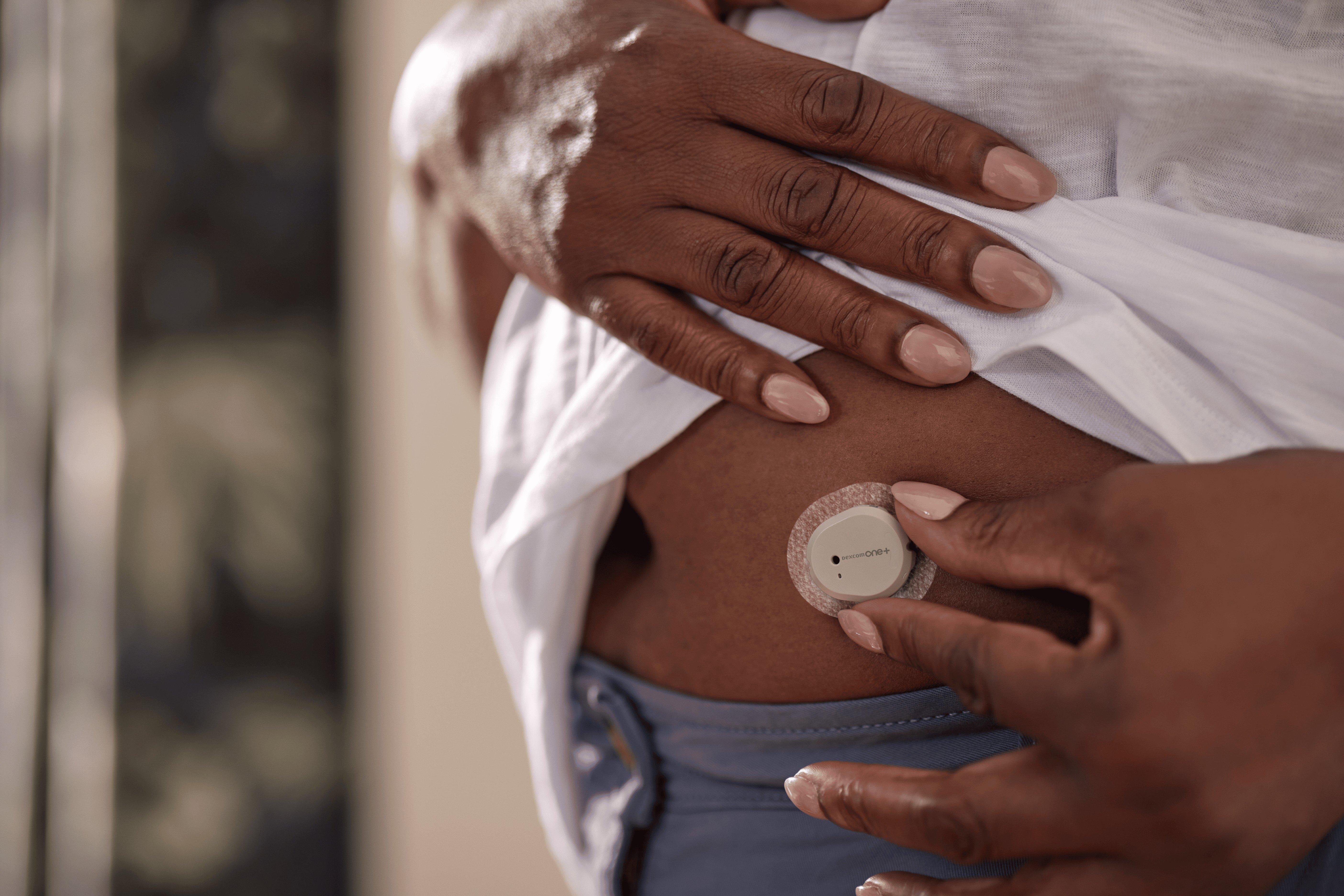 A Dexcom ONE sensor on the abdomen