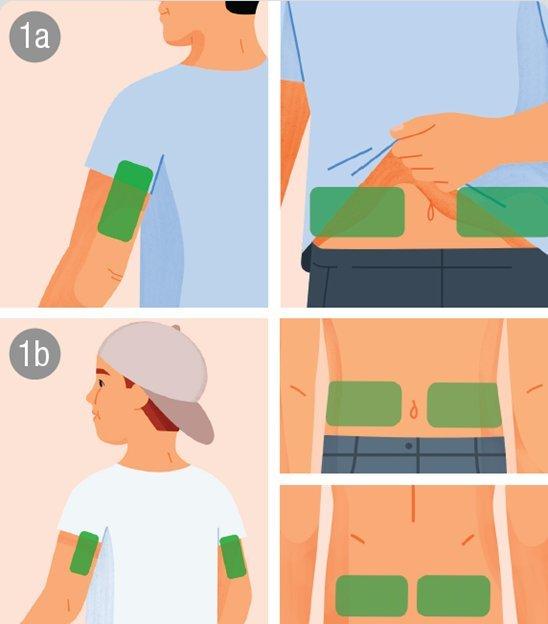 Where do I insert my Dexcom ONE+ sensor? | Dexcom