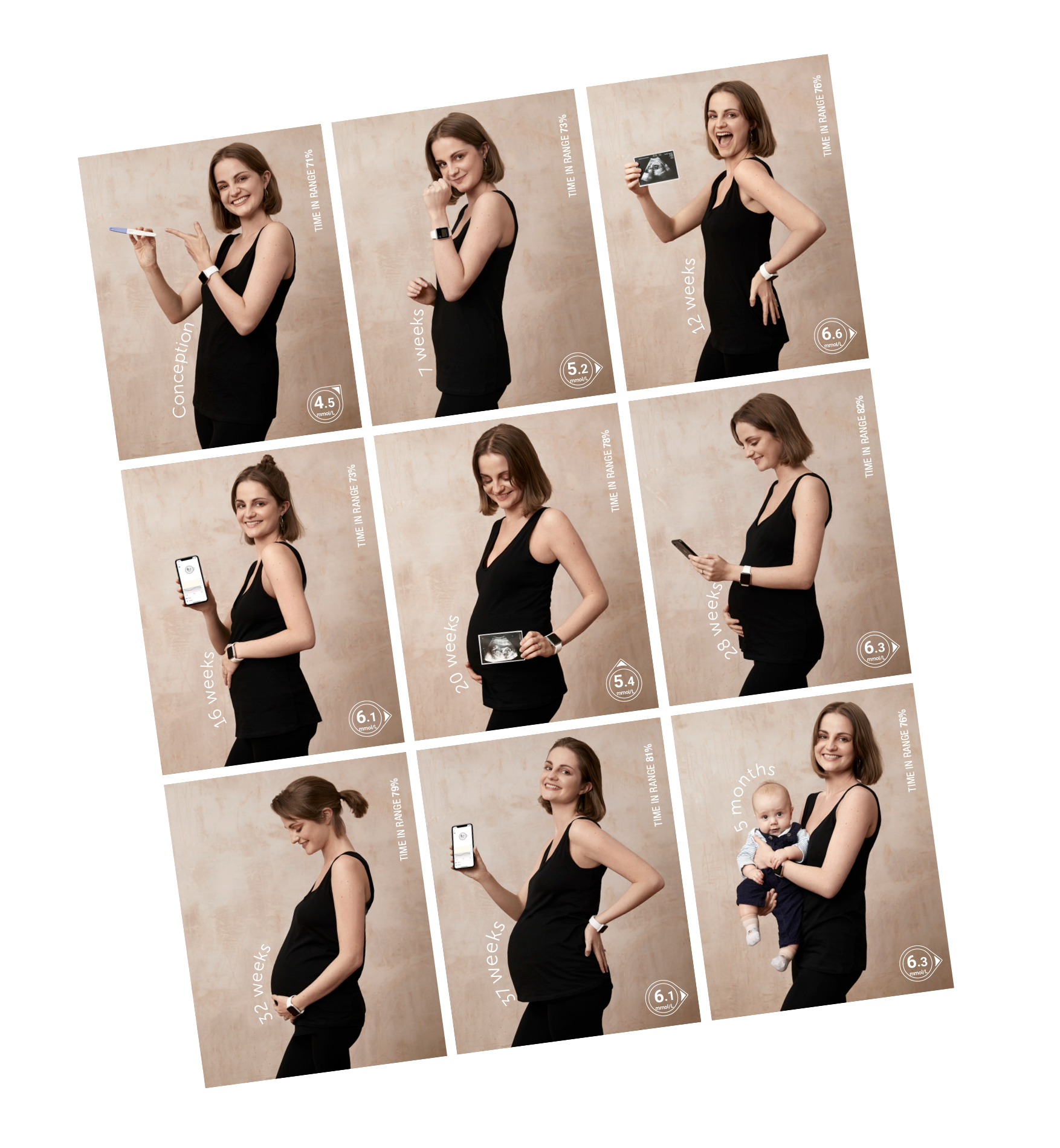 A woman uses Dexcom CGM during pregnancy