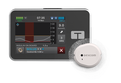Le Dexcom G7 s'intègre à la pompe à insuline Tandem t:slim X2 pour automatiser l'administration des bolus et maintenir le niveau de glucose dans les limites recommandées.