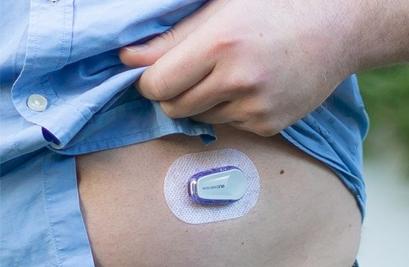 A Dexcom ONE sensor on the abdomen