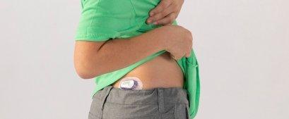 Dexcom G6 diabetes sensor can be worn on upper buttocks