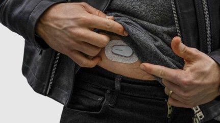 Dexcom G6 sensor on lower abdomen