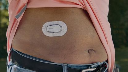 dexcom sensor on womens abdomen