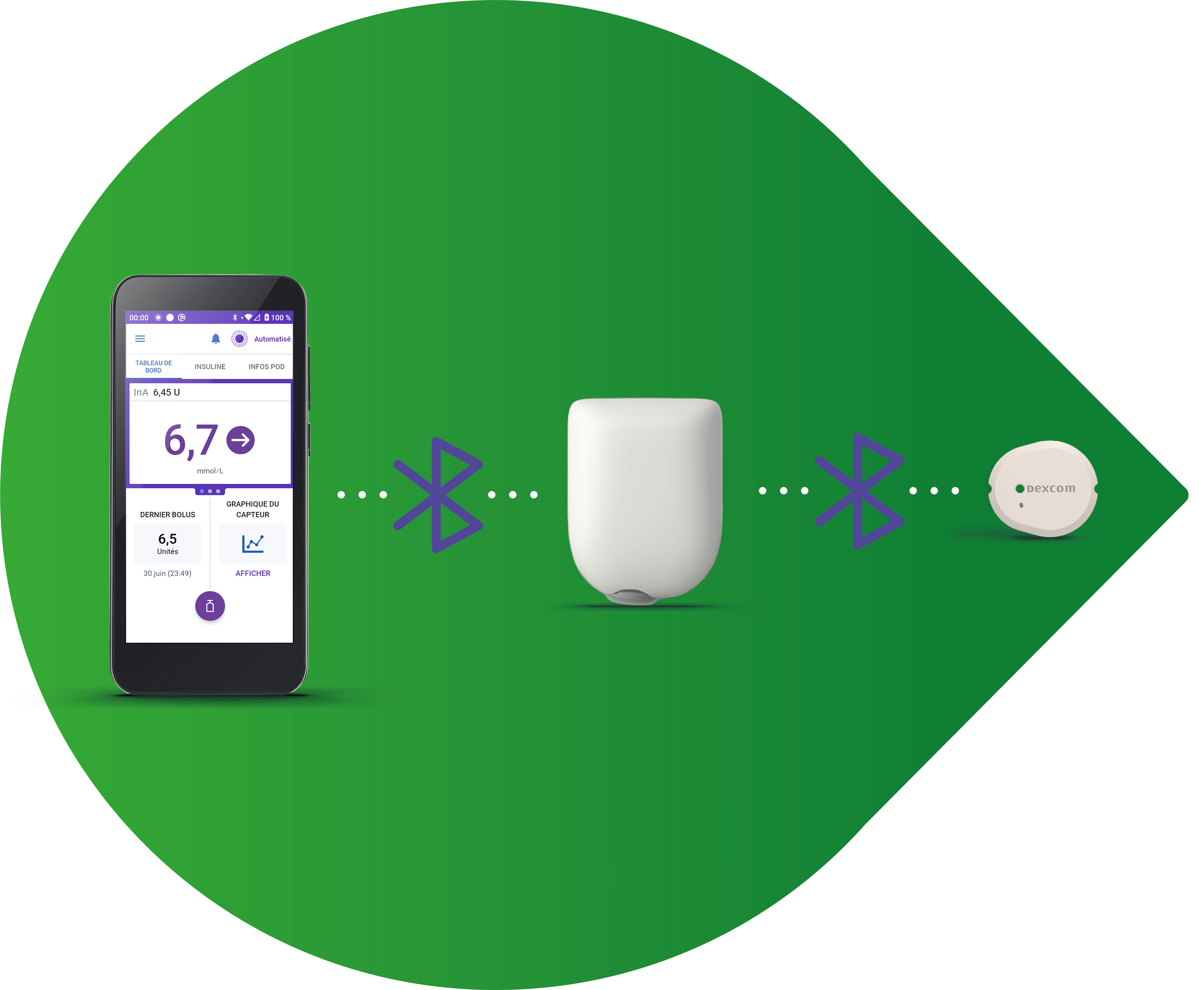 Automatisierte Insulindosierung mit Dexcom G7 und Omnipod 5