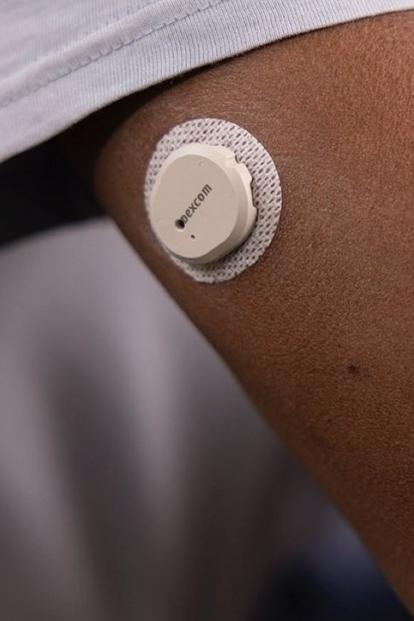 Dexcom G7 sensor placed on upper arm