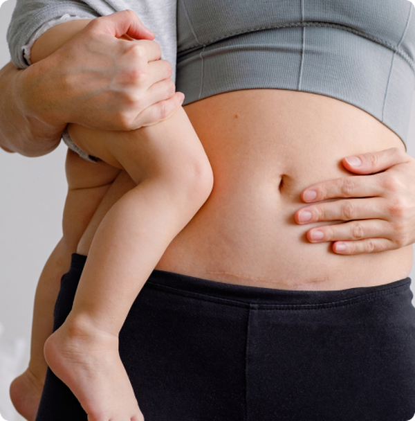 woman holding her belly with a c-section scar, holding a child