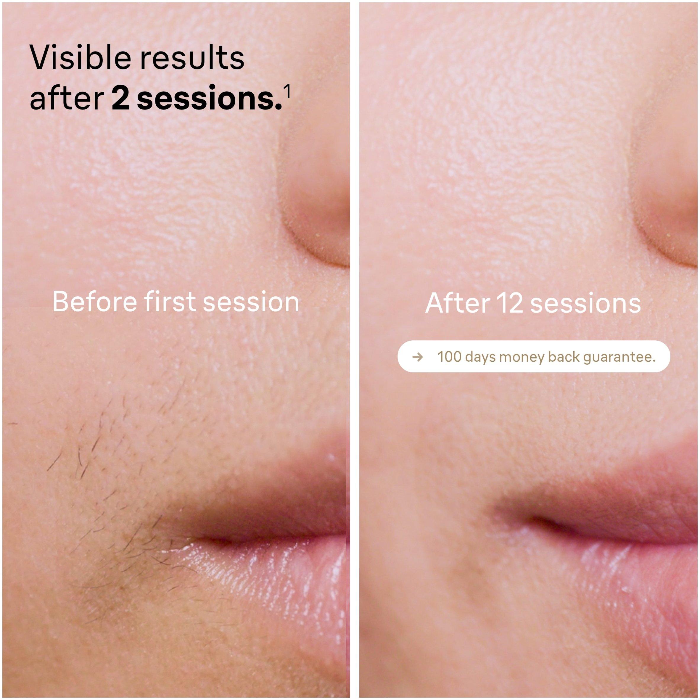 White - Braun - Braun IPL5347 Permanent Hair Removal - 5