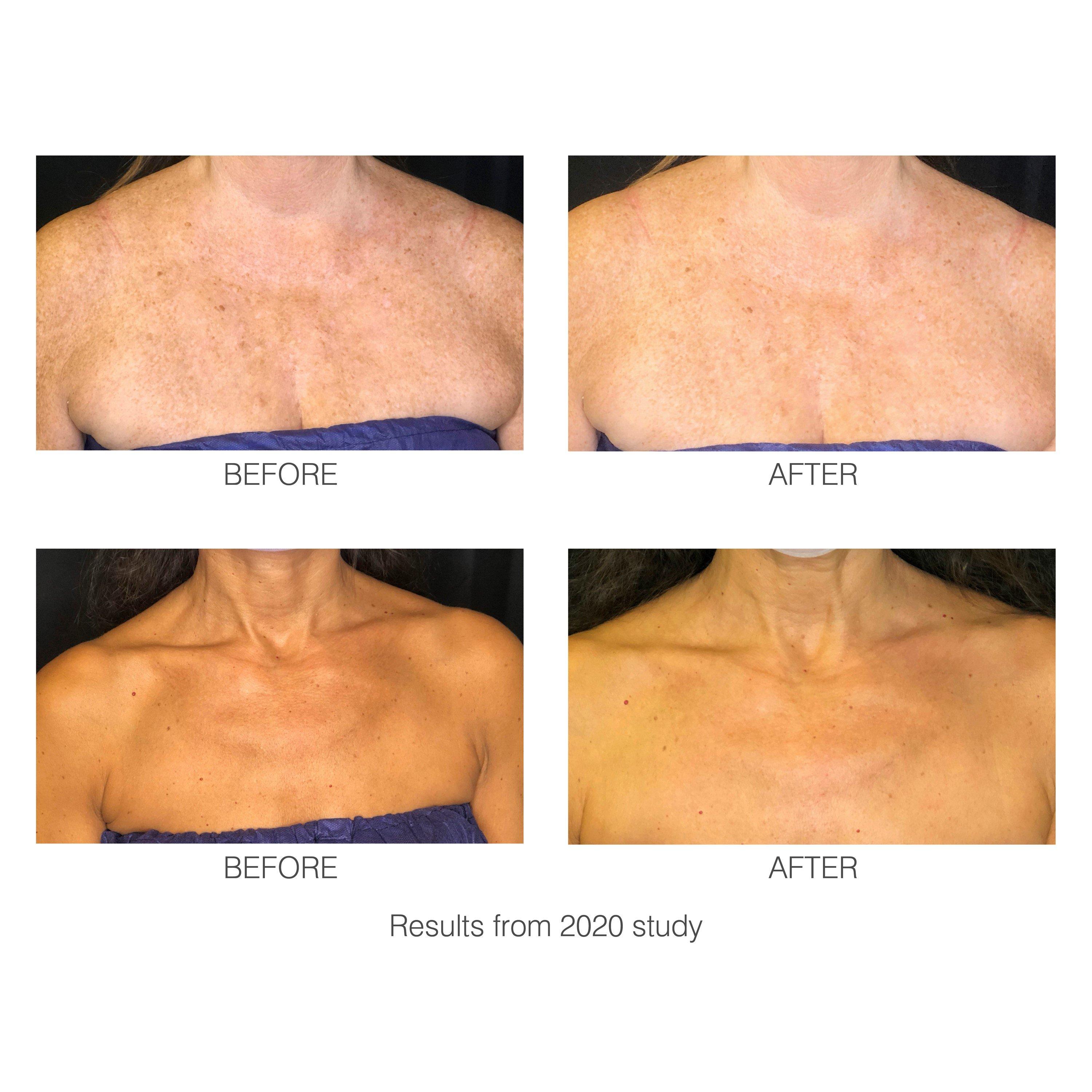 White - Rio - Rio decoLITE Beauty Treatment - 5