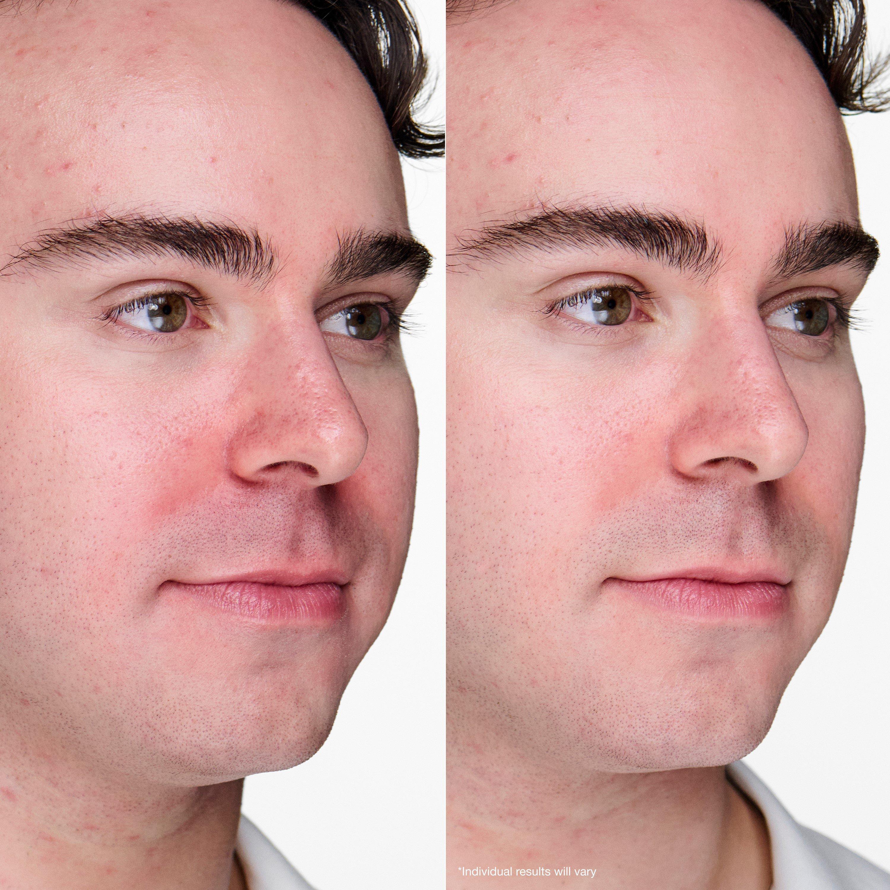 Clear - Clinique - Anti-Blemish Solutions Clinical Advanced Clearing Gel 10ml - 4