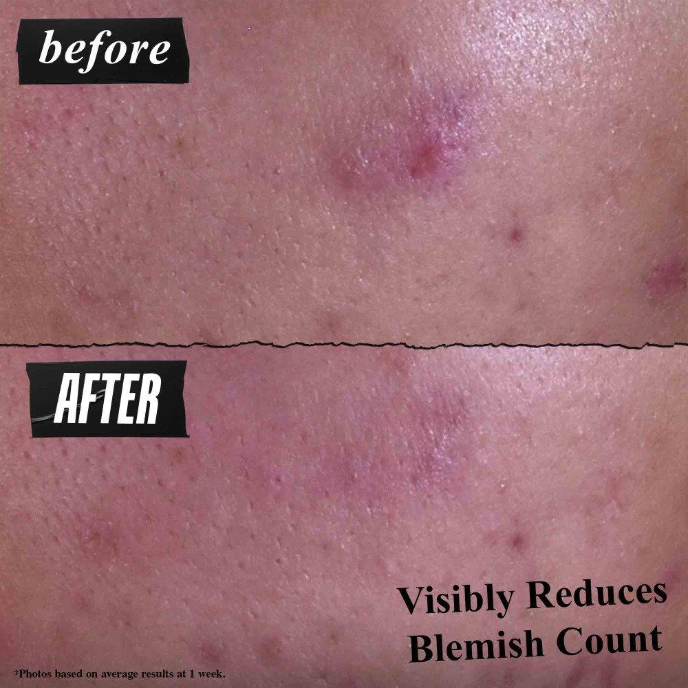 Clear - Kiehls - Gently Effective Blemish-Treating Cleansing Paste - 5