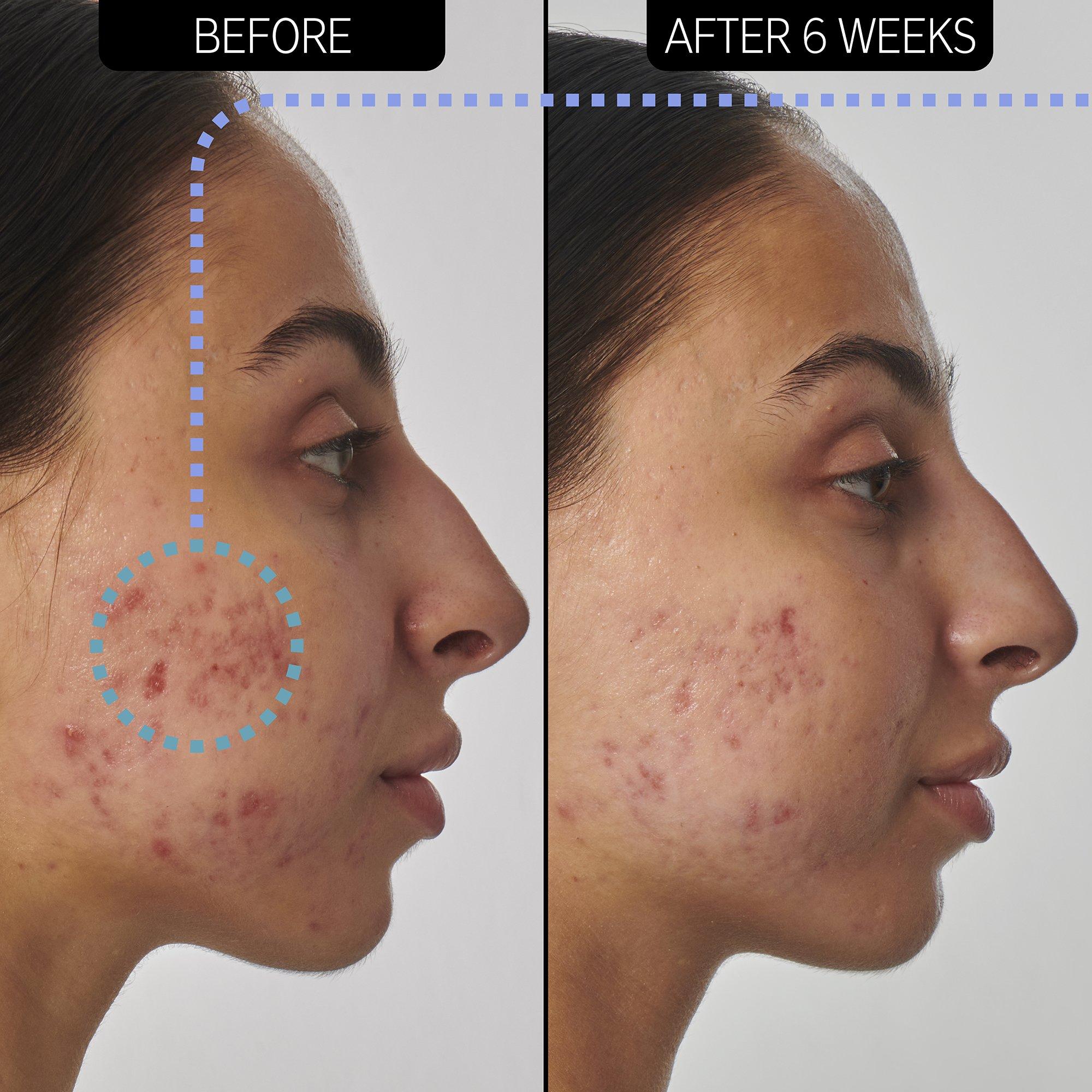 Clear - The Inkey List - Skin Solutions Retinol Serum - 4