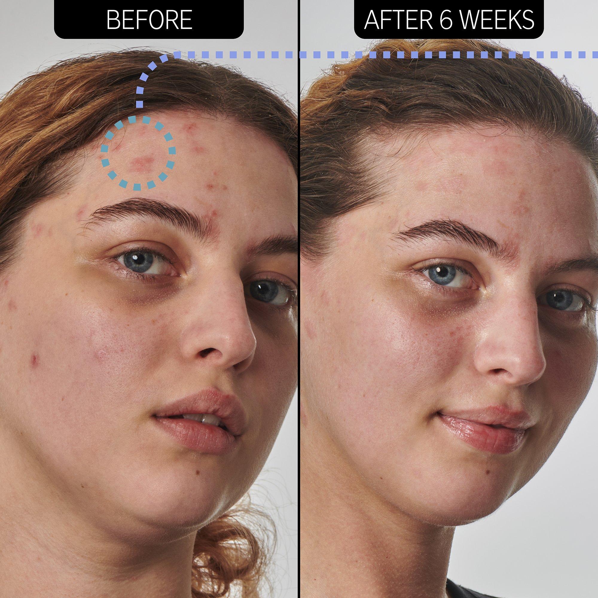 Clear - The Inkey List - Inkey Skin Solutions Urea Moisturiser - 4