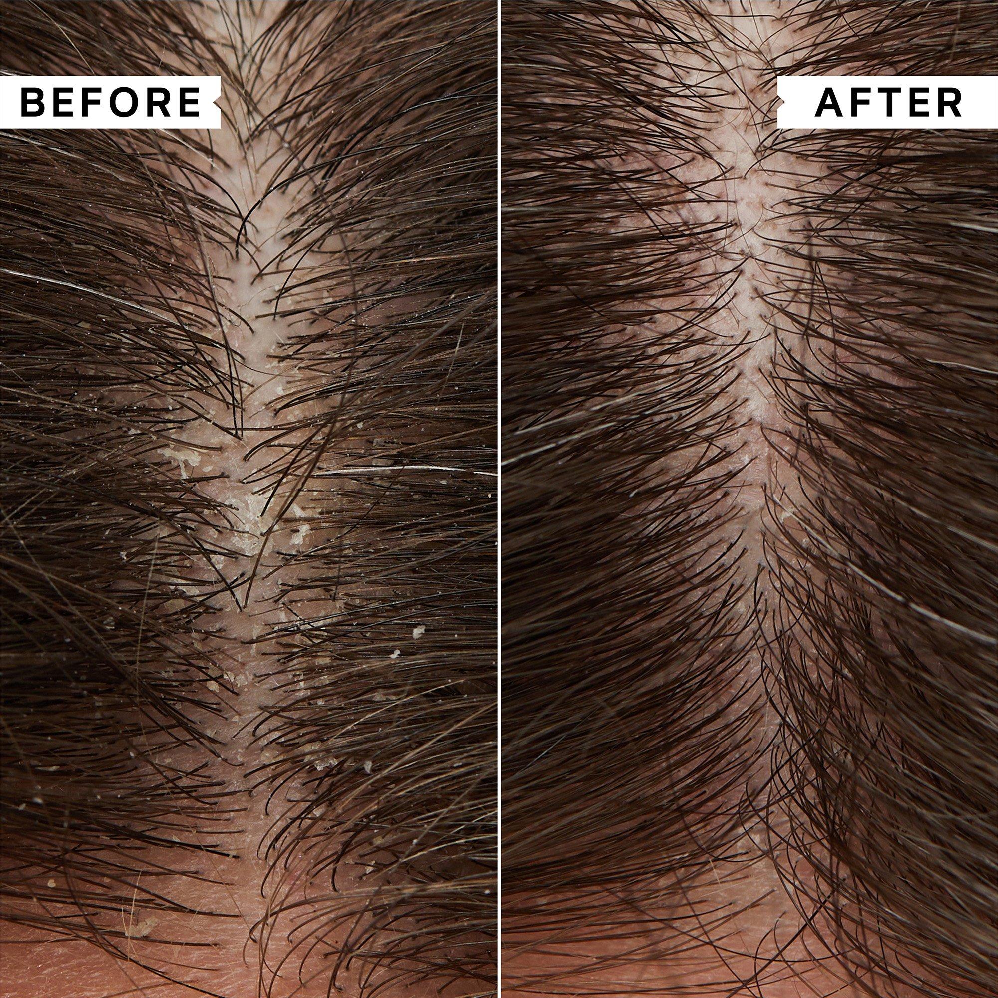 Clear - Philip Kingsley - Flaky/Itchy Scalp Mask 20ml x 2 - 2