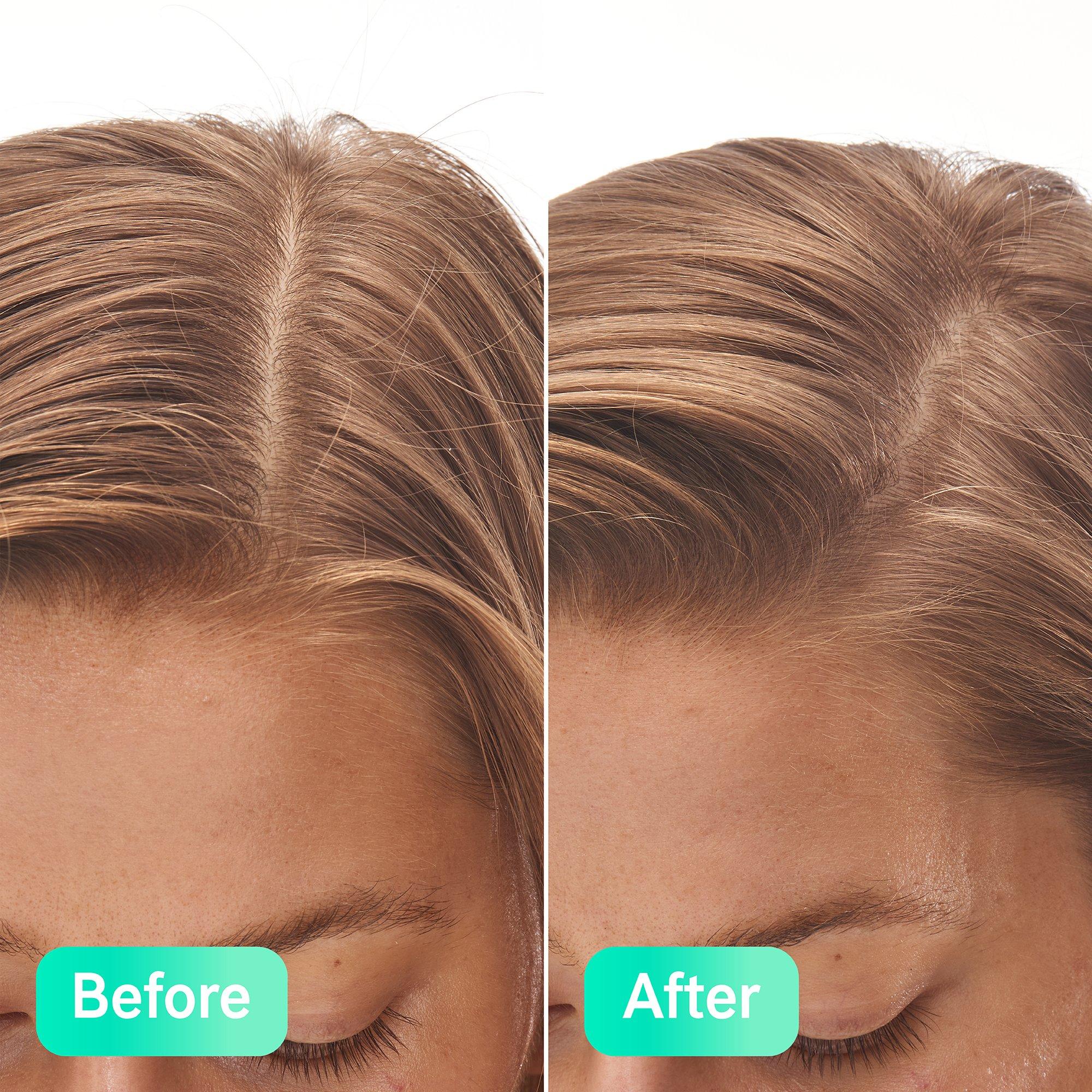 Serum - The Inkey List - Salicylic Acid Exfoliating Scalp Treatment - 9