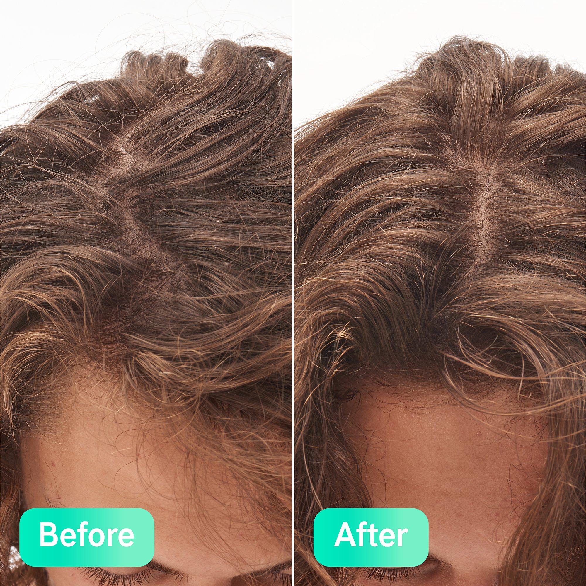 Serum - The Inkey List - Glycolic Acid Exfoliating Scalp Treatment - 10