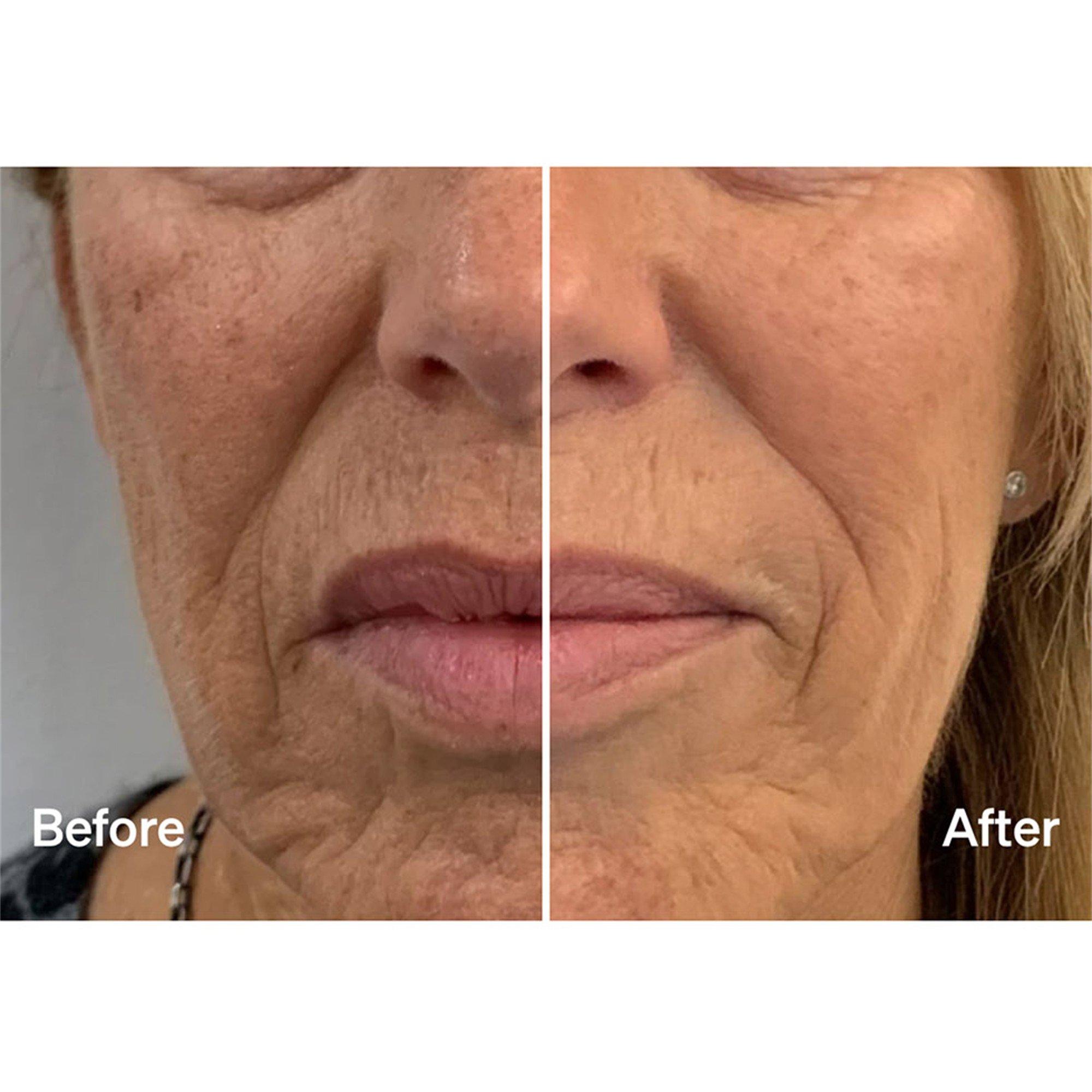 Not Applicable - LYMA - MIST & GLIDE REILL 60 DAY - 4