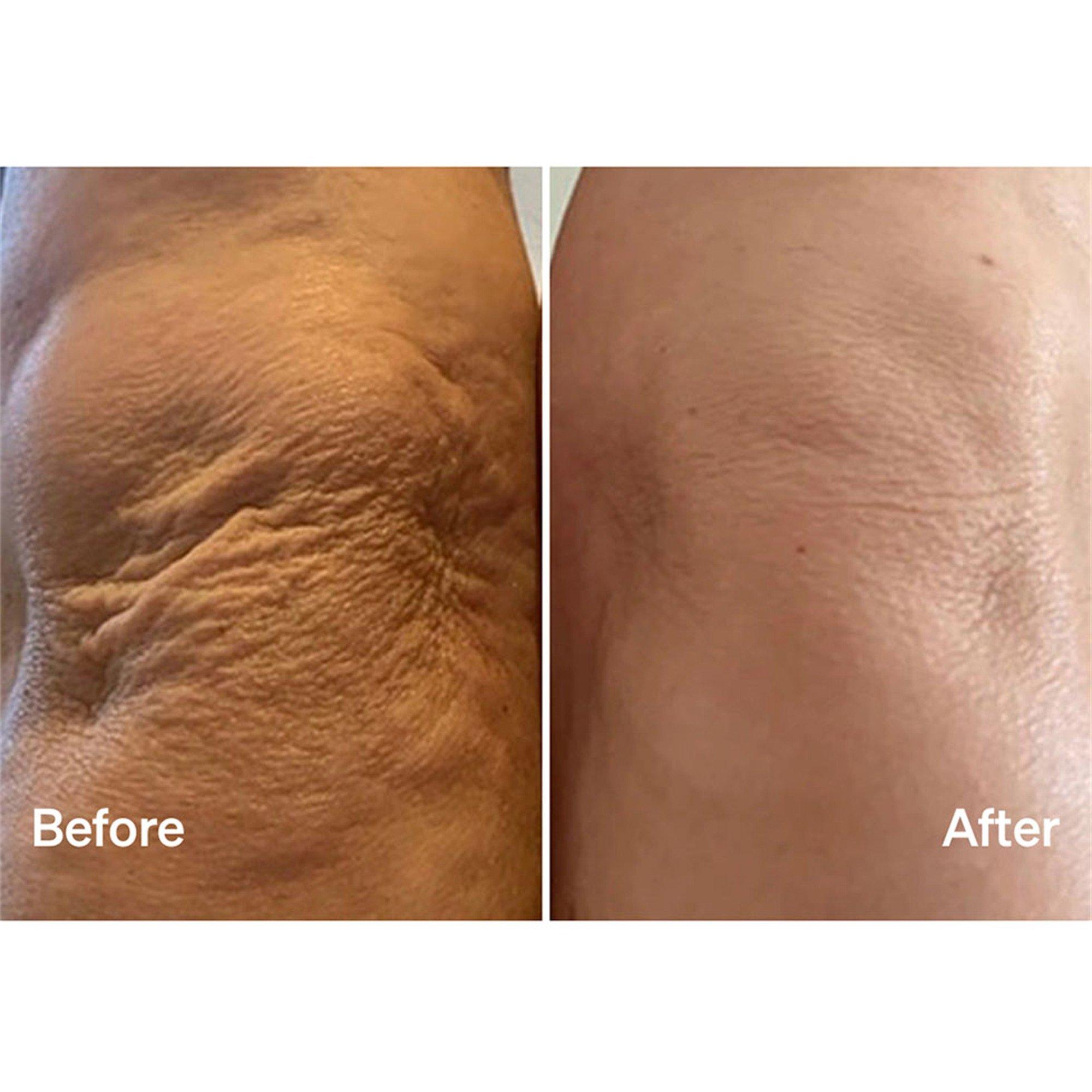 Not Applicable - LYMA - MIST & GLIDE REILL 60 DAY - 5