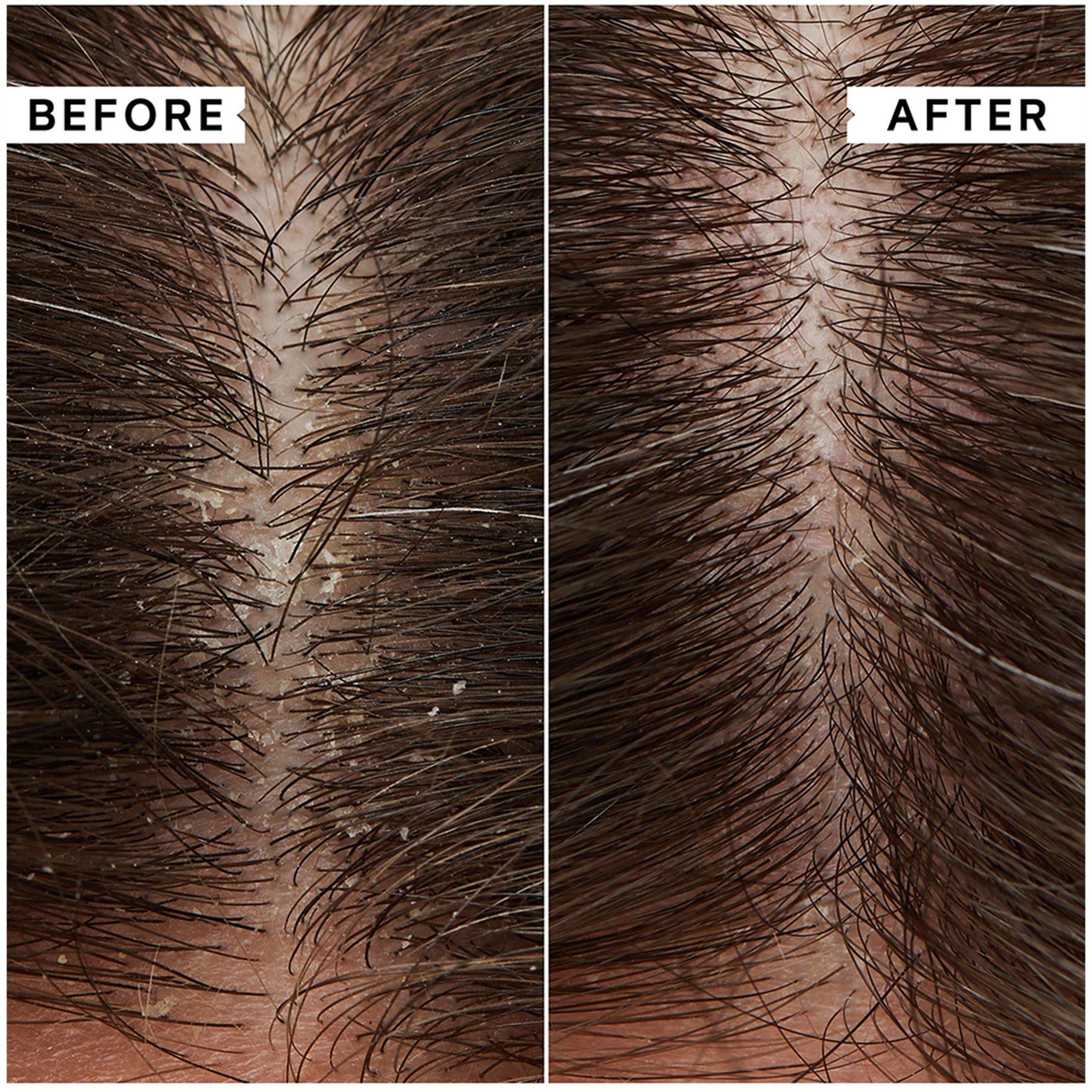 Not Applicable - Philip Kingsley - FLAKY/ITCHY SCALP ANTI-DA - 3