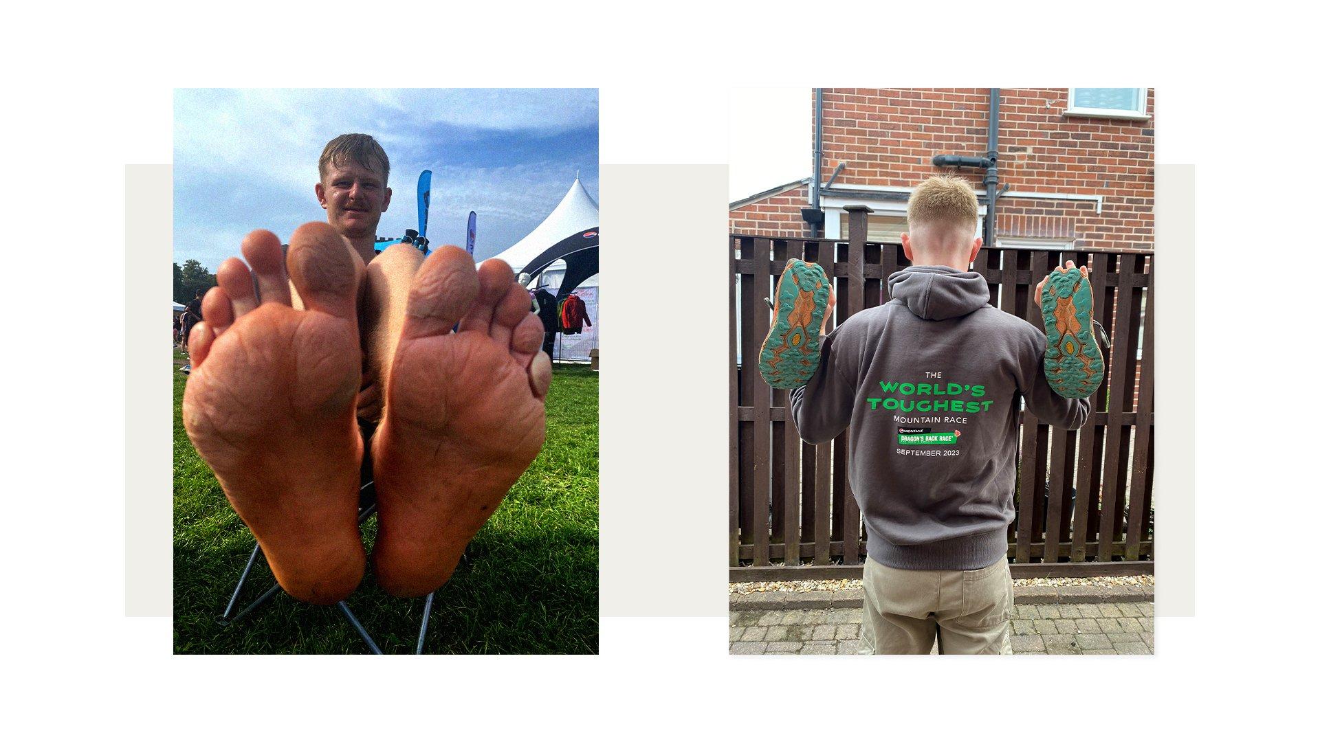Owen Jackson's feet after six days of running during the Montane Dragon's Back Race