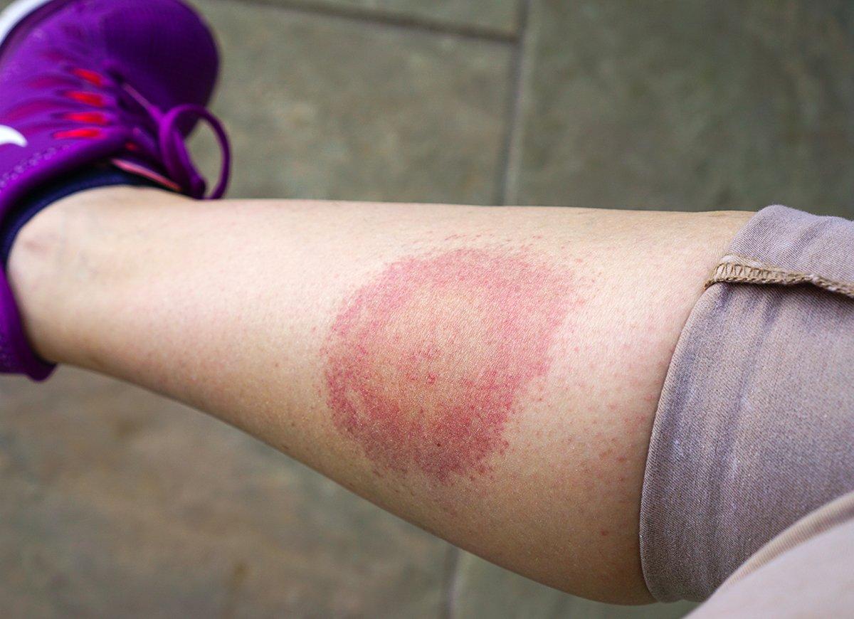 A bull's-eye rash can be a symptom of Lyme disease. Image by Anastasia Kopa/Shutterstock