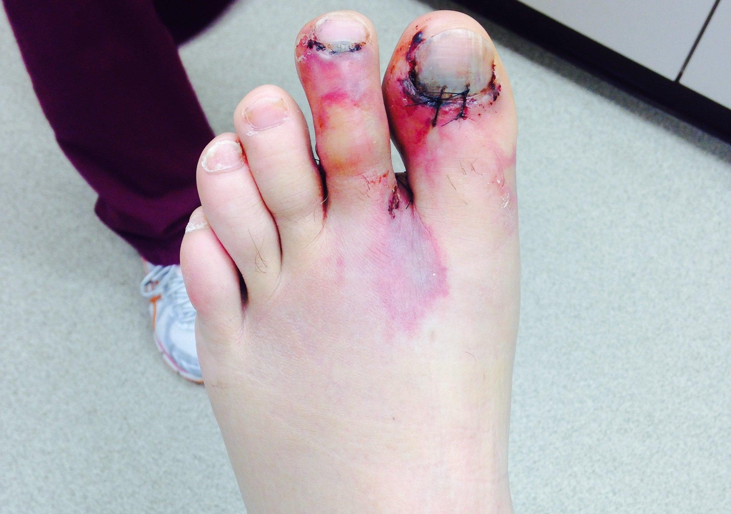 Lee Lakosky fractured toes