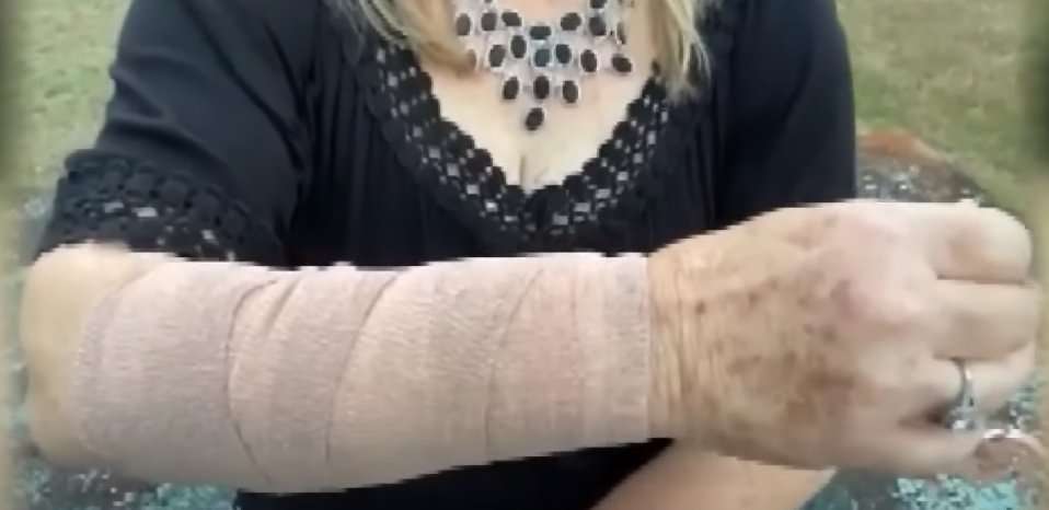 Woman Suffers Severe Arm Injuries After Snake Falls on Her and Hawk ...