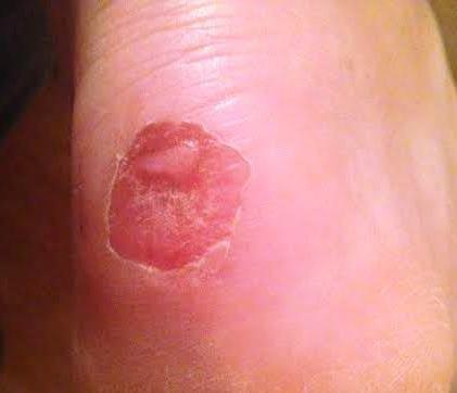 Blister