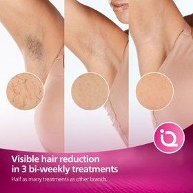 Visible hair reduction in 3 bi-weekly treatments